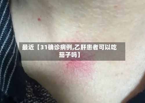 最近【31确诊病例,乙肝患者可以吃茄子吗】-第2张图片