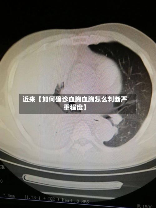 近来【如何确诊血胸血胸怎么判断严重程度】